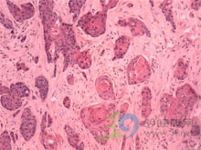 从齿至26一30处,21, 鳞状细胞癌(squamous cell carcinoma)简称鳞癌