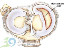 膝盖半月板损伤如何治疗?