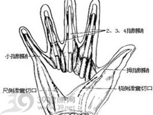 手指屈肌腱鞘炎