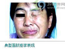 撇 右脸比左脸大 颜面肌分表情肌和咀嚼肌两部分,前者由面神经支配