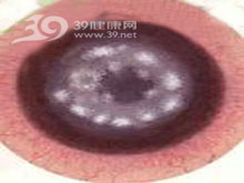 眼眶真菌病(orbital mycosis) 发病率极低,致病菌常见有毛霉菌,曲霉菌