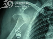 不小心把手摔断了,说是骨头错位了,可以动手术吗?