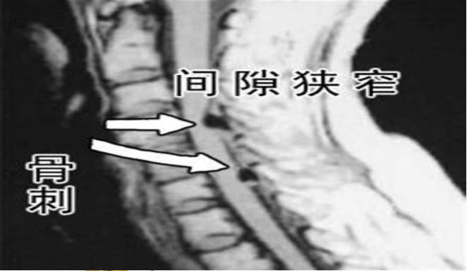 肩周炎