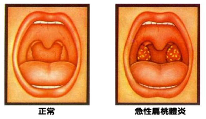 急性扁桃体炎的症状图片,急性扁桃体炎图片大全_急性扁桃体炎_39疾病