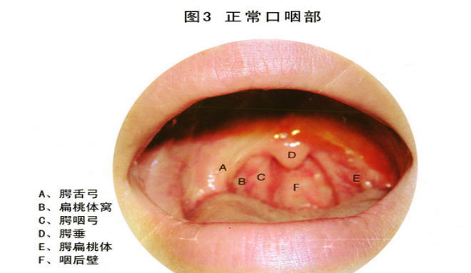 慢性咽炎的症状图片,慢性咽炎图片大全_慢性咽炎_39疾病百科