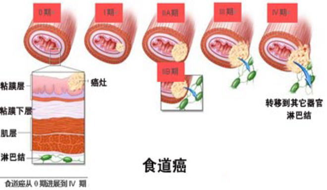 食道癌