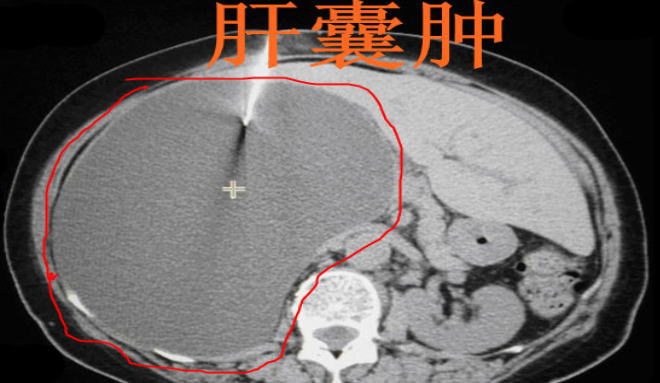 肝囊肿的症状图片,肝囊肿图片大全_肝囊肿_39疾病百科