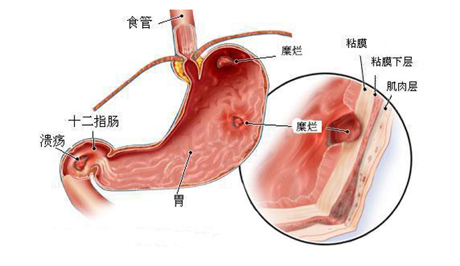 胃炎的症状图片,胃炎图片大全 胃炎 39疾病百科 