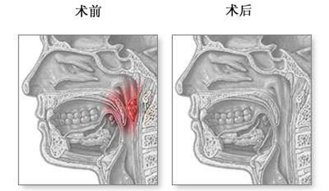 腺样体肥大