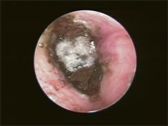 真菌 症 外耳道