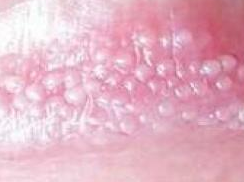 皮肤性病科 性病科 梅毒     环状糜烂性龟头炎是常见的包皮龟头炎的