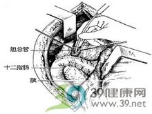 十二指肠乳头括约肌成形术(经十二指肠)