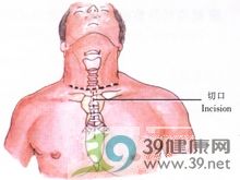 隆突切除重建术及支气管袖式切除术