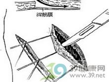 管状皮瓣(皮管)移植术