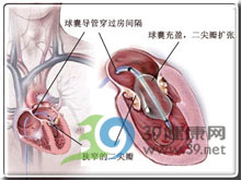 心脏瓣膜扩张术