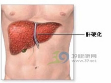 肝细胞脂肪性变