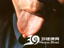 舌咬伤