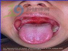舌齿龈疼痛性粟粒至水疱