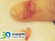 手指和足趾无痛性软组织肿块