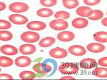 红细胞分布宽度偏低