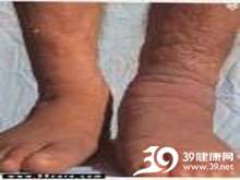 胫前和足部坚硬的非凹陷性水肿斑块