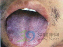 青紫舌