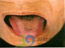 舌干苔厚