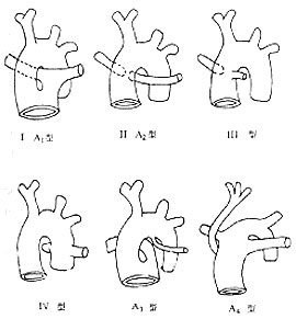 圖1 永存動脈幹解剖畸形分類示意圖i型 動脈幹部分分隔,肺動脈主幹起