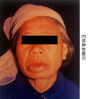 肉芽肿性唇炎(granulomatous cheilitis)好发于青春后期男女,多见为