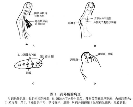 拇外翻断骨手术步骤图图片