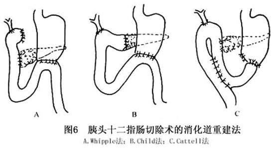 胆肠吻合图片