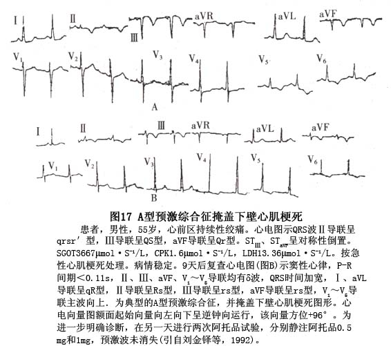 预激综合征b型 www.jqw.com