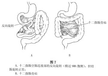 小兒腸旋轉不良