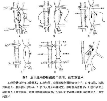 透析瘘管手术步骤图解图片