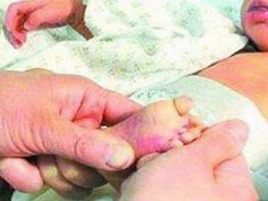 蚕豆病_蚕豆病的症状,治疗,好评专家_疾病查询_39疾病百科