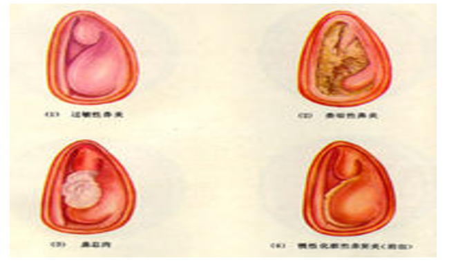 宝宝鼻息肉图片图片