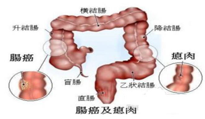 横结肠癌症状图片