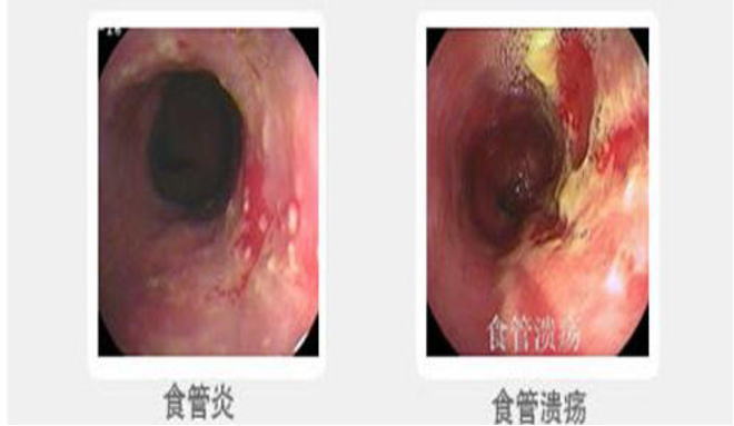 反流性食管炎的症状图片,反流性食管炎图片大全 反流性食管炎 39疾病百科 