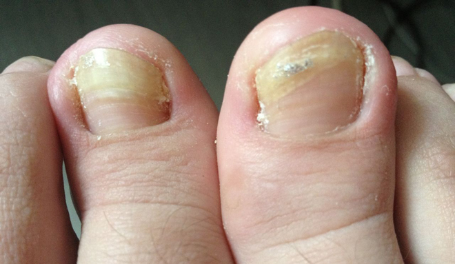 甲沟炎的症状图片,甲沟炎图片大全_甲沟炎_39疾病百科