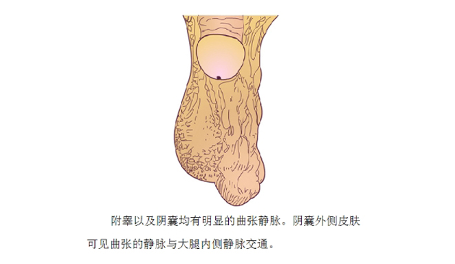 左侧精索静脉曲张图图片