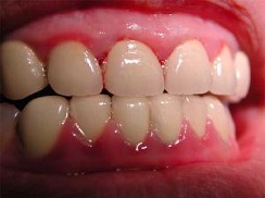 先天梅毒牙齿症状图片图片
