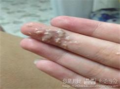 豆腐渣样白带是女性在患有霉菌性阴道炎的时候常常表现的症状,