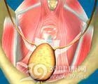 妇产科 妇科 阴道口   阴道壁脱垂包括有尿道膨出,膀胱膨出,子宫后