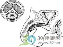 前尿道延伸阴茎伸直位固定法