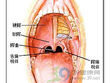 新生儿口腔高腭弓图片图片