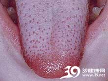 梅毒长在舌头上的图片图片